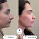 Slider image (10) Dra. Renata Cardenas-Aesthetic & Fuctional Rhinoplasty